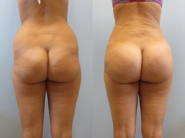 Liposuction Before & After