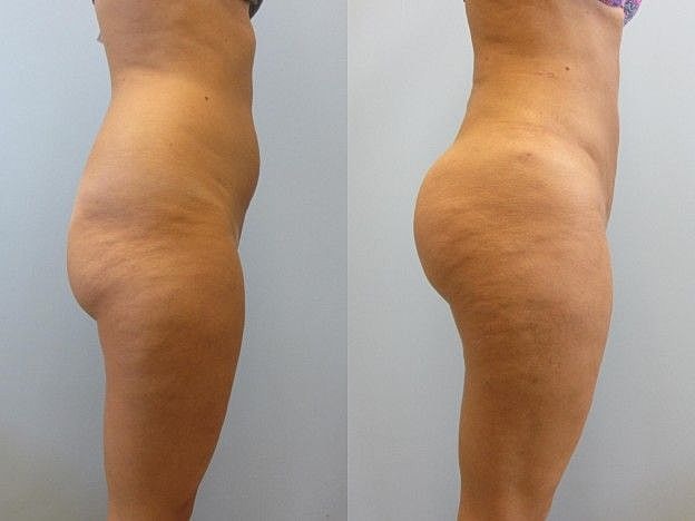Liposuction Before & After