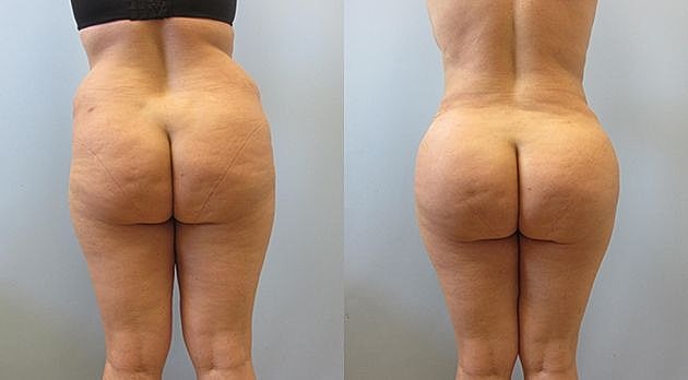 Liposuction Before & After