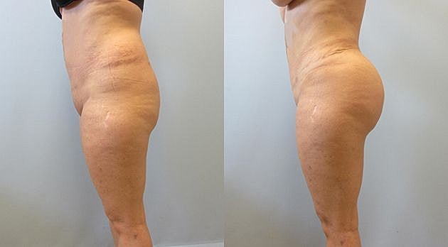 Liposuction Before & After