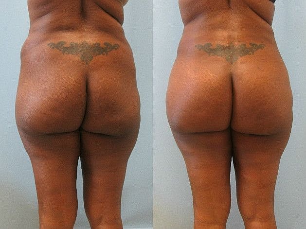 Liposuction Before & After