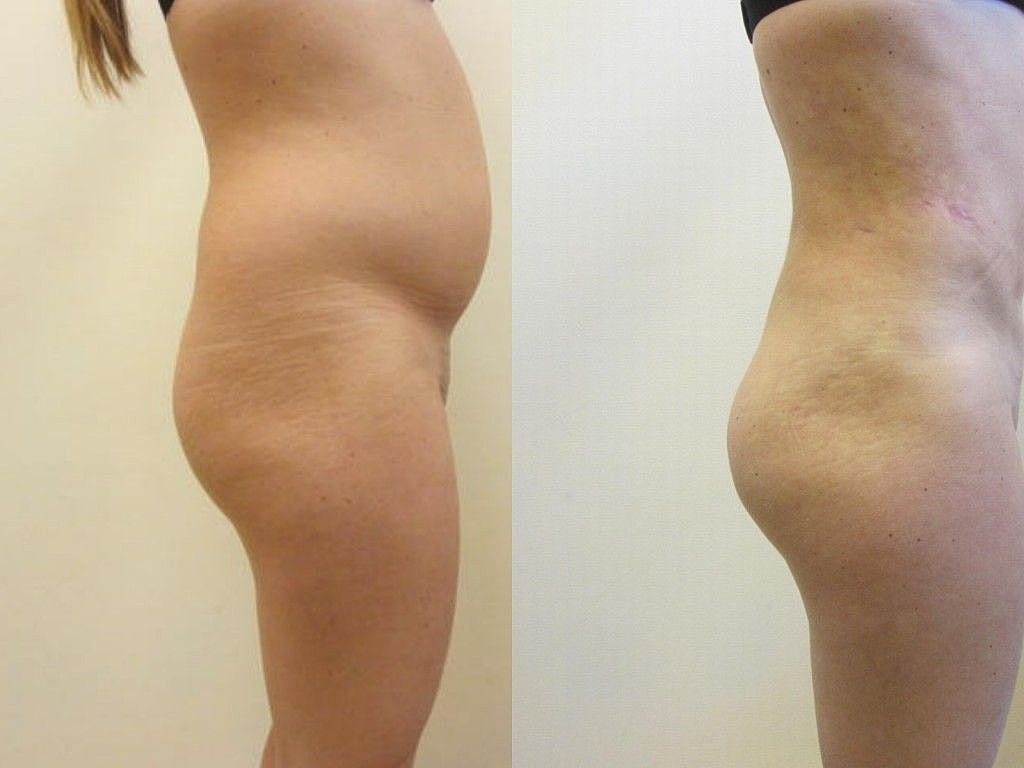 Liposuction Before & After