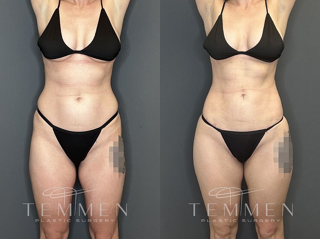 Liposuction Before & After