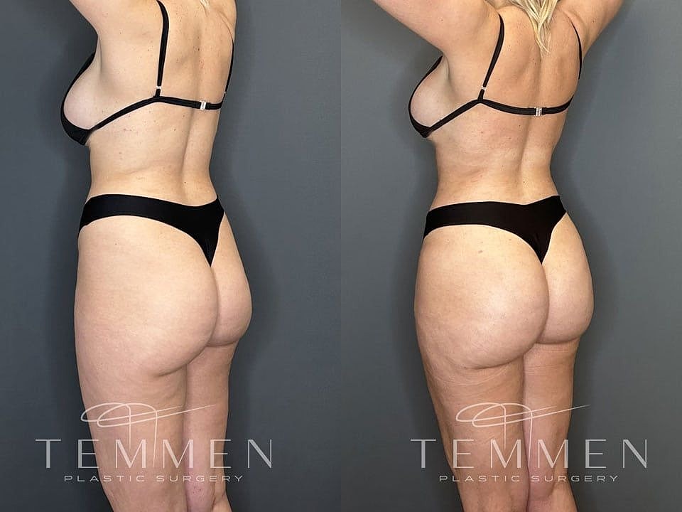 Liposuction Before & After