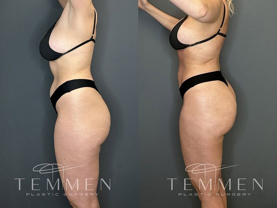 Liposuction Before & After