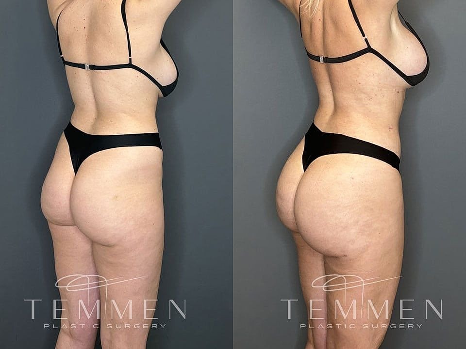Liposuction Before & After