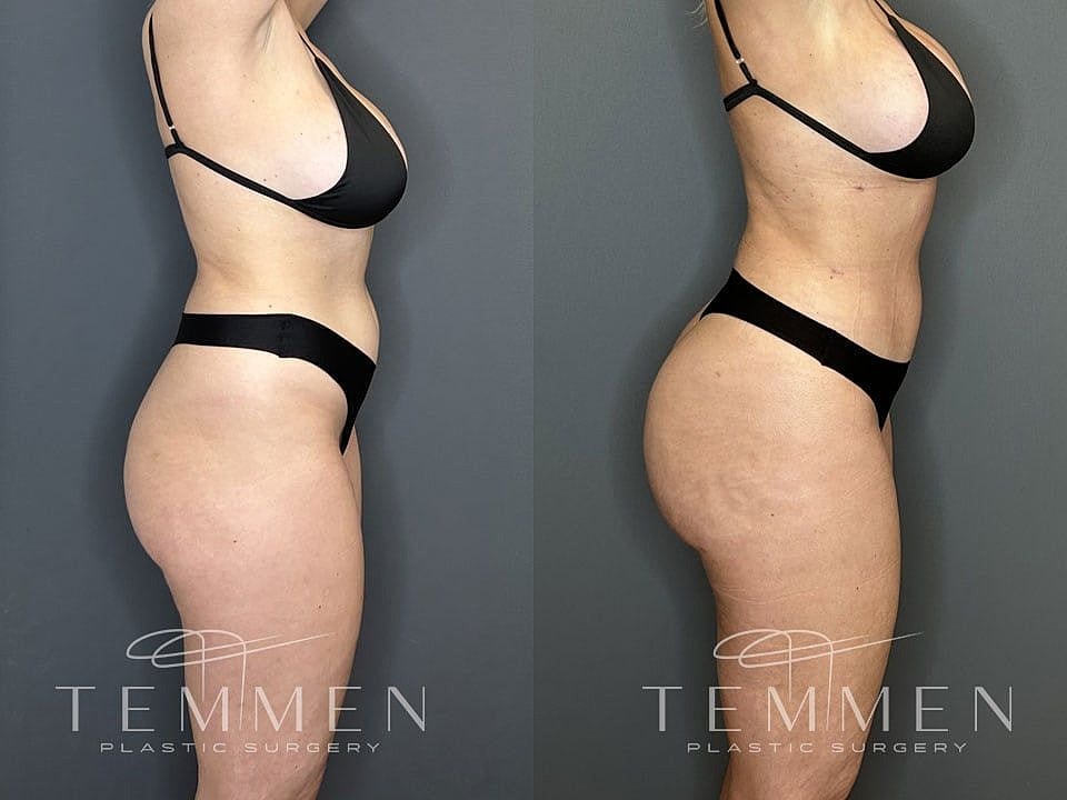 Liposuction Before & After