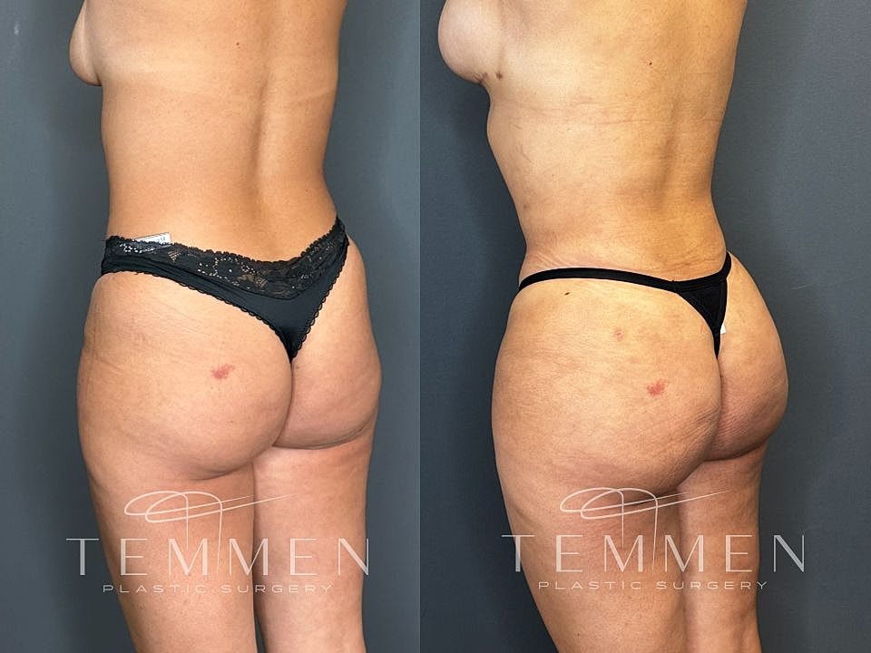 Liposuction Before & After