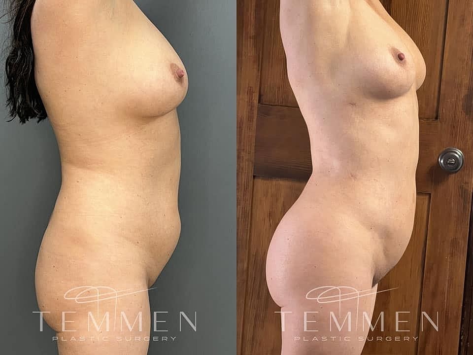Liposuction Before & After