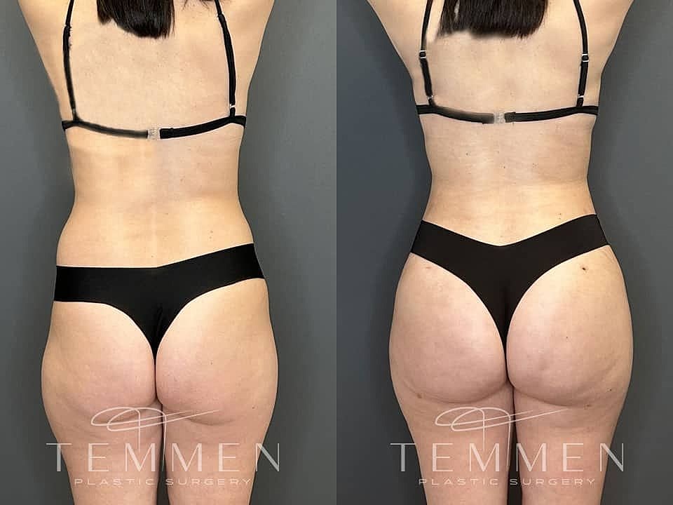 Liposuction Before & After