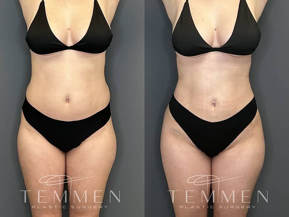 Liposuction Before & After