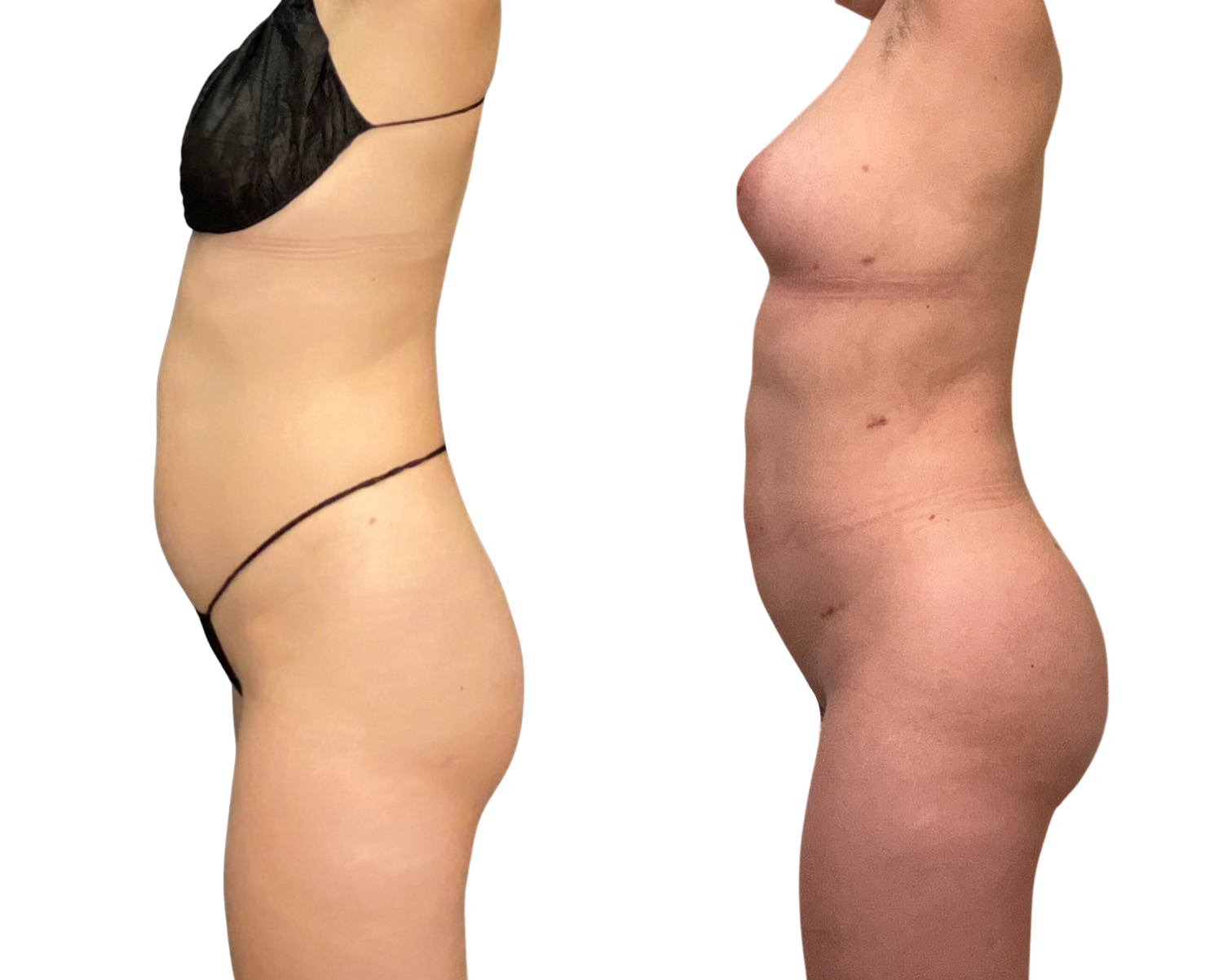 Liposuction Before & After