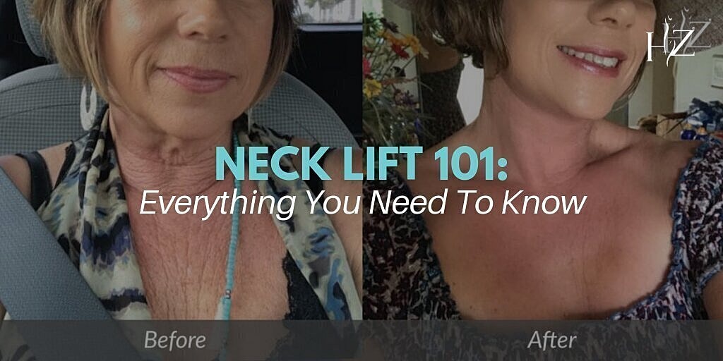 neck lift before and after from vado plastic surgery