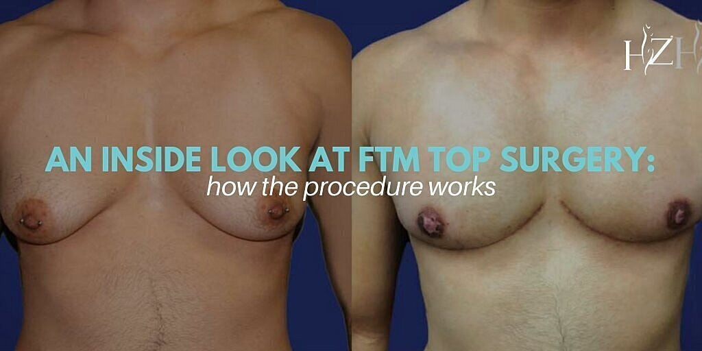 FTM top surgery before and after