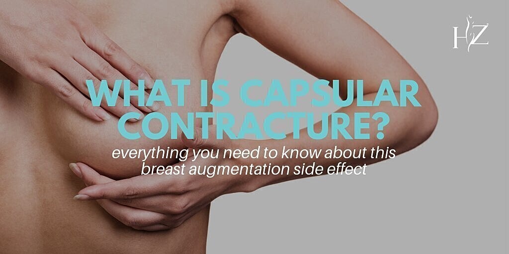 what is capsular contracture, capsular contracture, breast augmentation, breast augmentation side effect, what causes capsular contracture, capsular contracture repair, capsular contracture orlando, capsular contraction repair in orlando, Vado plastic…