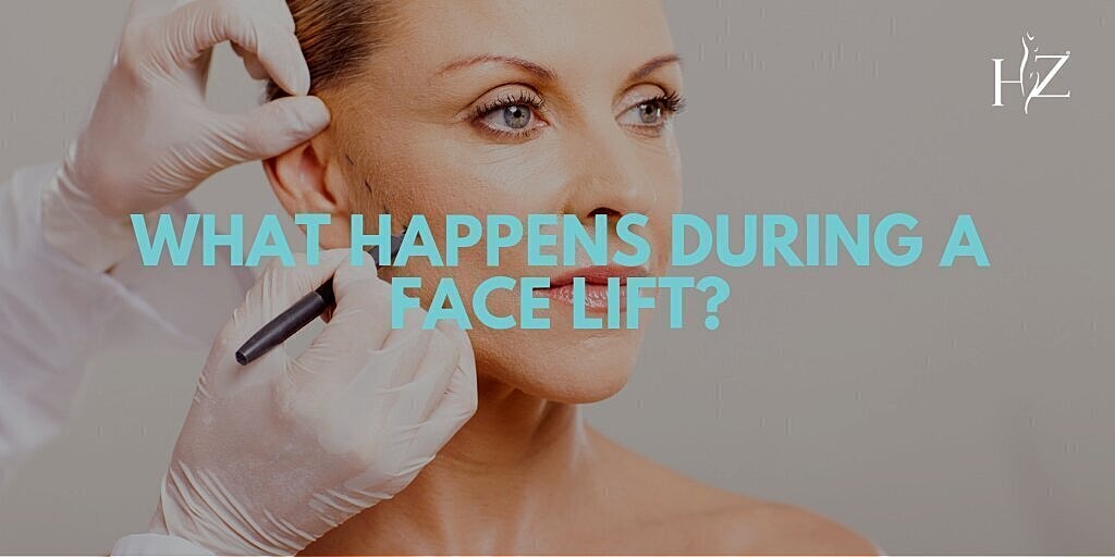 what happens during a face lift, face lift, what is a face lift, types of face lifts, face lift incisions, what does a face lift treat, face lift before and afters, face lift results, face lift recovery, face lift orlando, face lift surgeon, Vado plas…