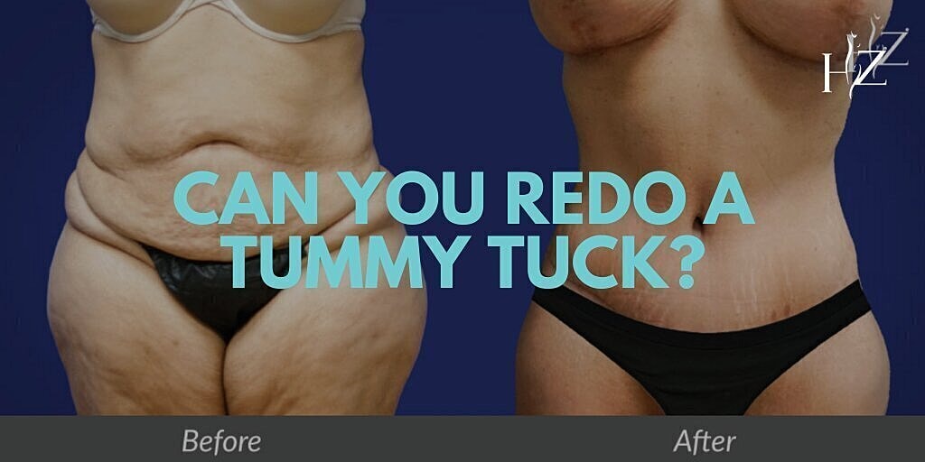 tummy tuck patient before and after
