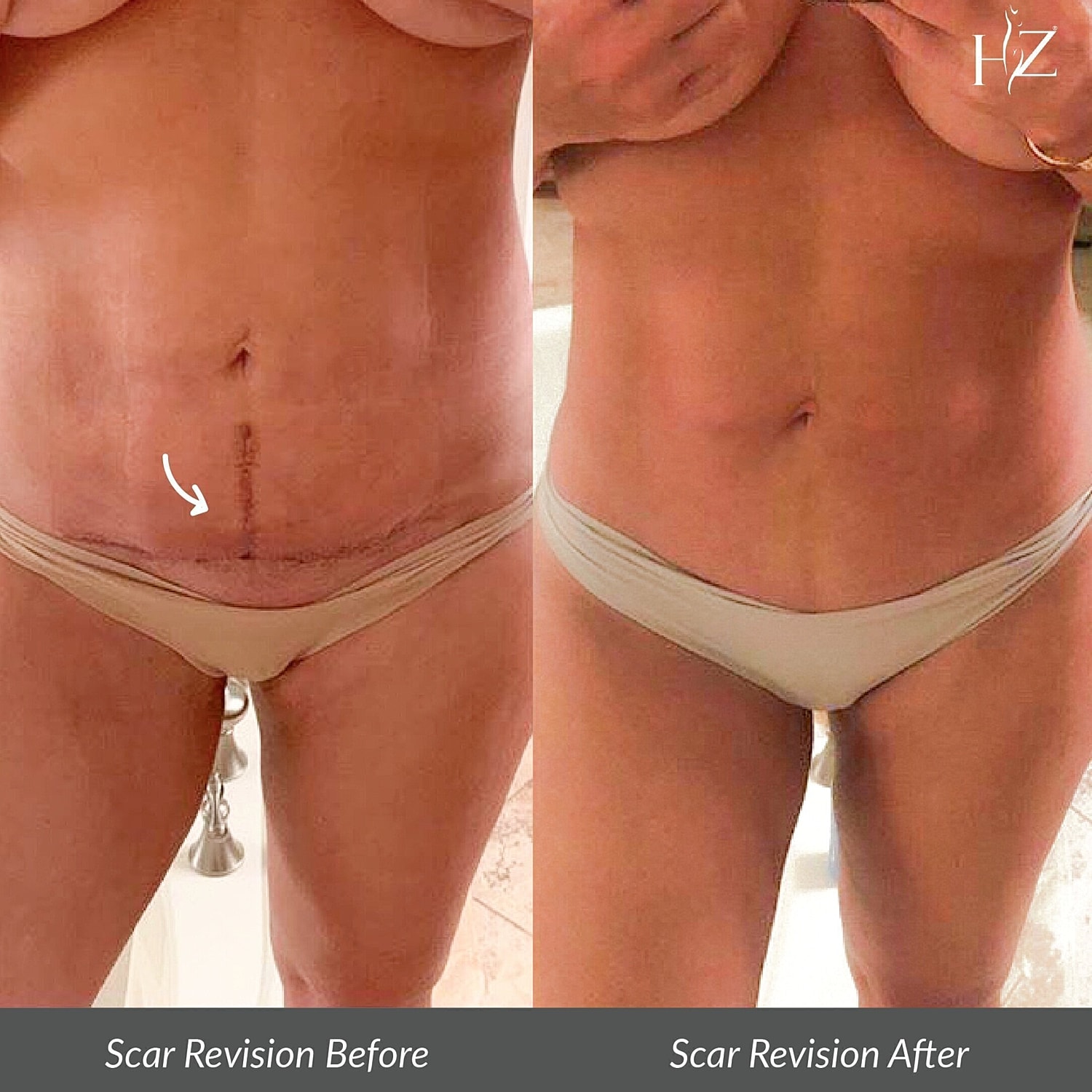 scar revision surgery before and after