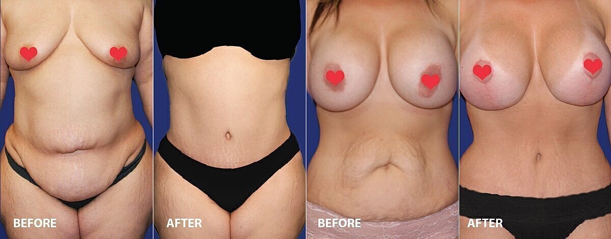 Belly button, belly button after a tummy tuck, tummy tuck, tummy tuck surgery, tummy tuck surgery in Orlando, what happens to your belly button after a tummy tuck, Vado Plastic Surgery, extended tummy tuck, full tummy tuck, mini tummy tuck, what are t…