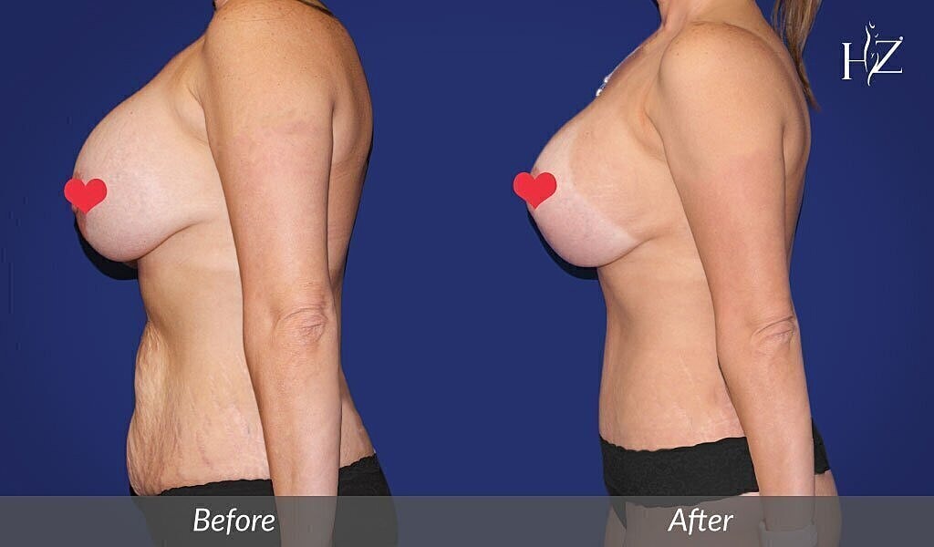 mommy makeover before and after