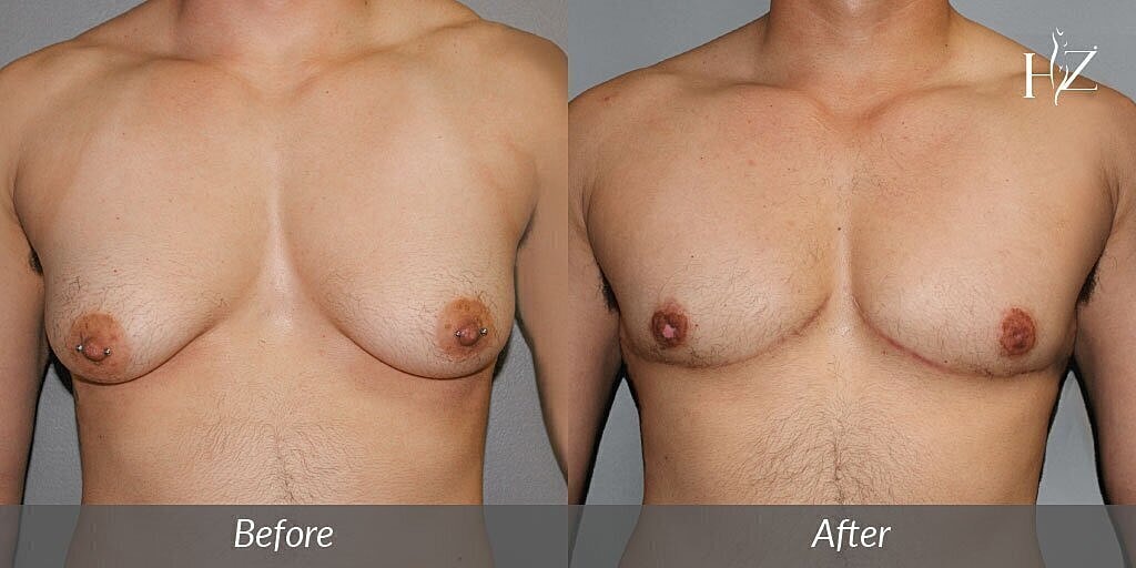 ftm top surgery before and after
