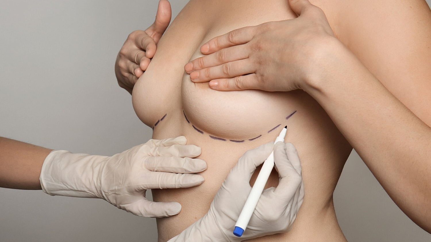 breast augmentation patient model covering her nipples with her hands and getting marked for surgery