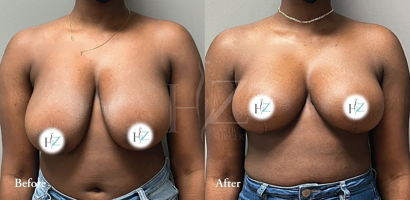 breast reduction patient model before and after 1
