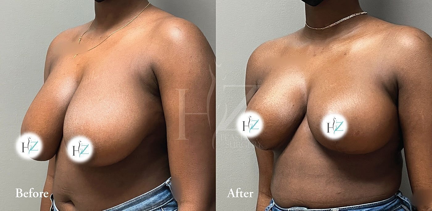 breast reduction patient model before and after 2