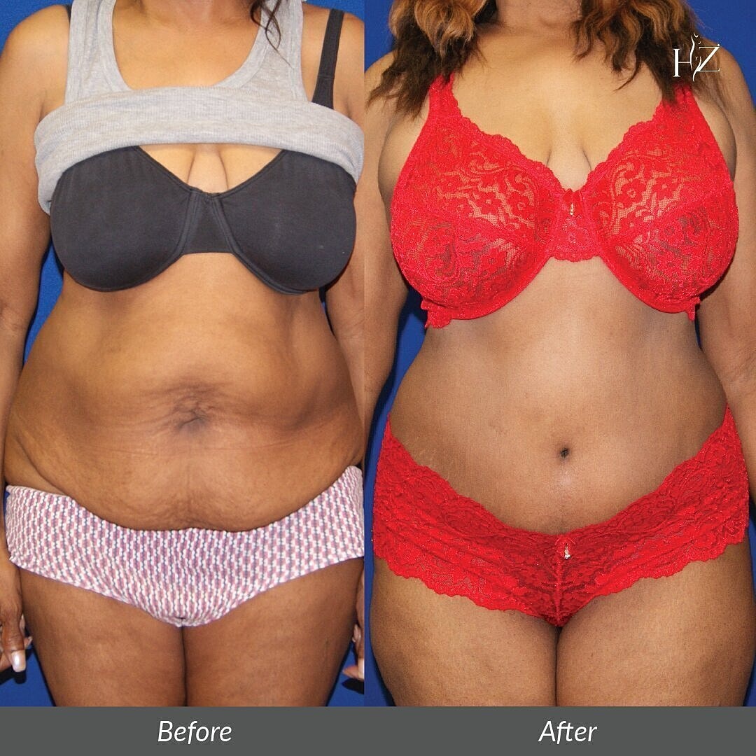 tummy tuck before and after orlando, Vado Plastic Surgery