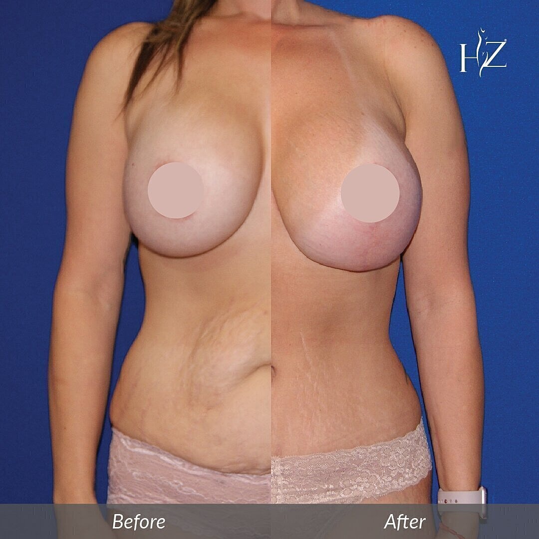 mommy makeover orlando, before and after orlando, Vado Plastic Surgery