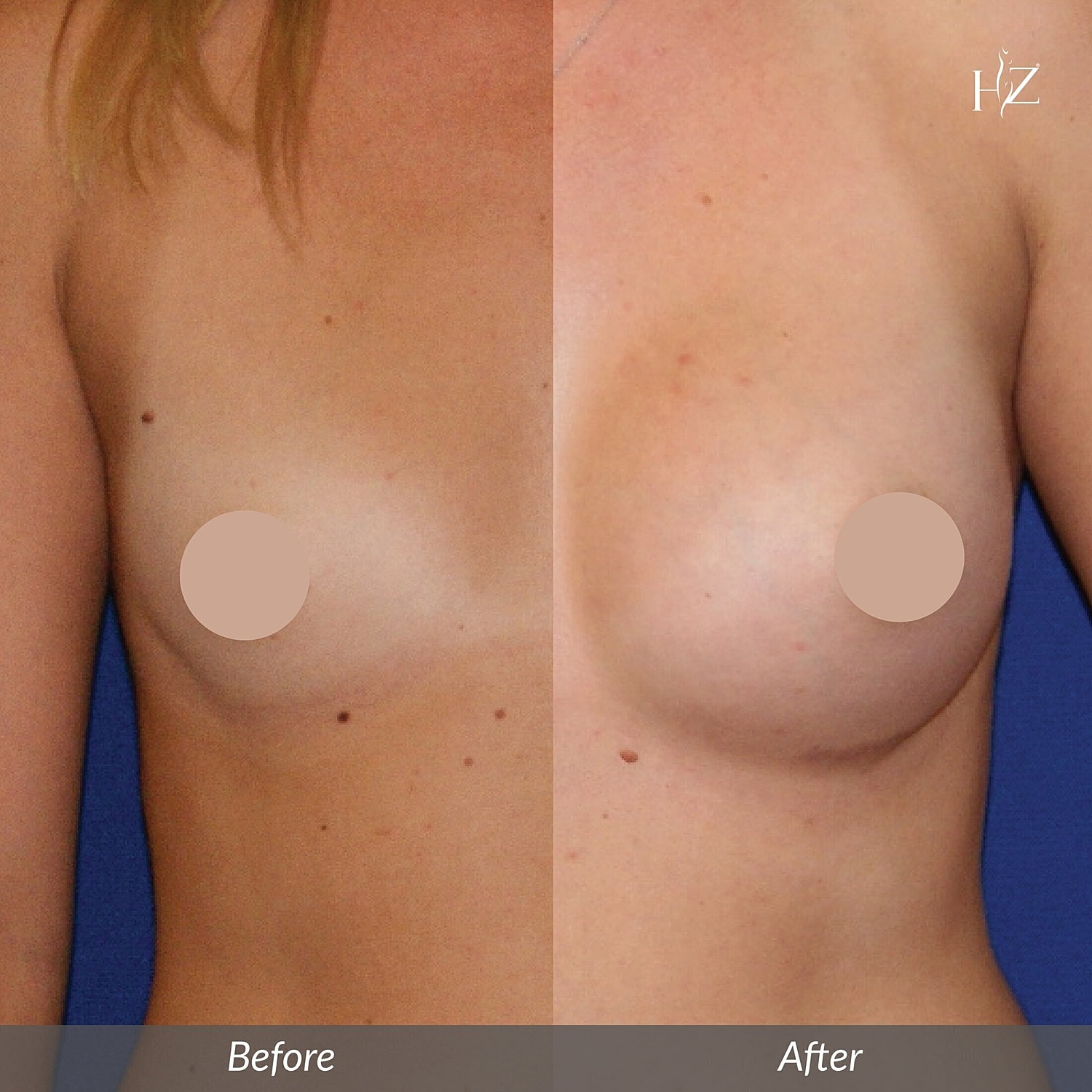 breast augmentation orlando, breast augmentation before and after, Vado Plastic Surgery