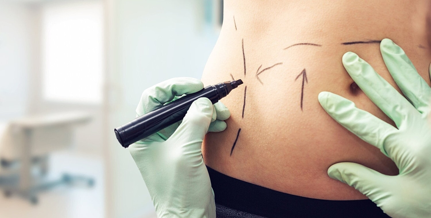 what is a mommy makeover, how much does a tummy tuck cost, plastic surgery near orlando, tummy tuck cost, mommy makeover orlando, tummy tuck orlando,