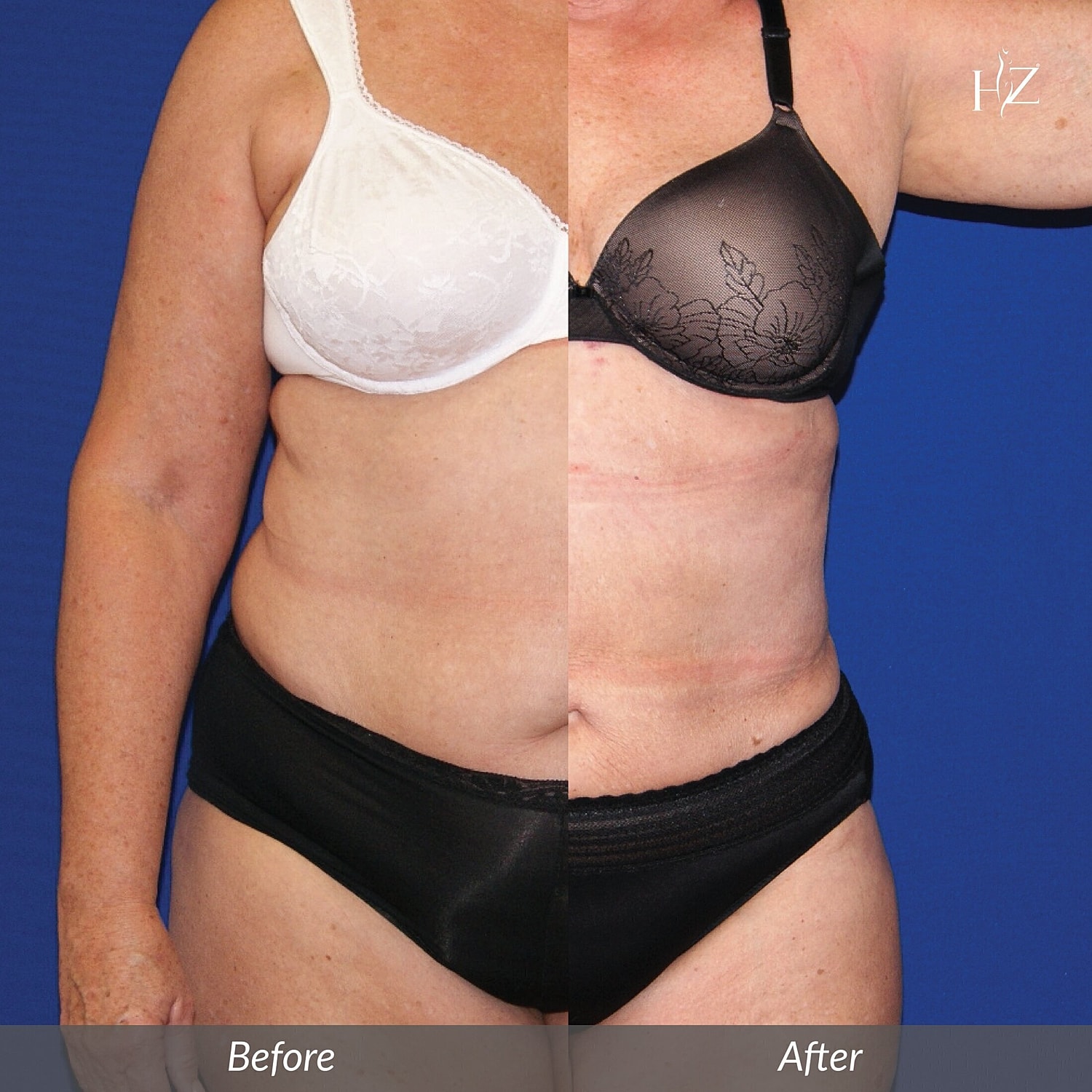 liposuction orlando, liposuction before and after, Vado Plastic Surgery