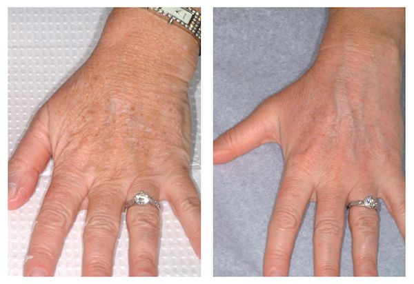 Comparison of two hands with different skin appearances.