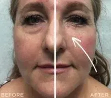 Tear Trough Treatment results with Restylane®, Juvederm® or Vollure