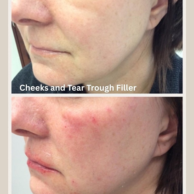 Nasolabial Folds Filler Before & After
