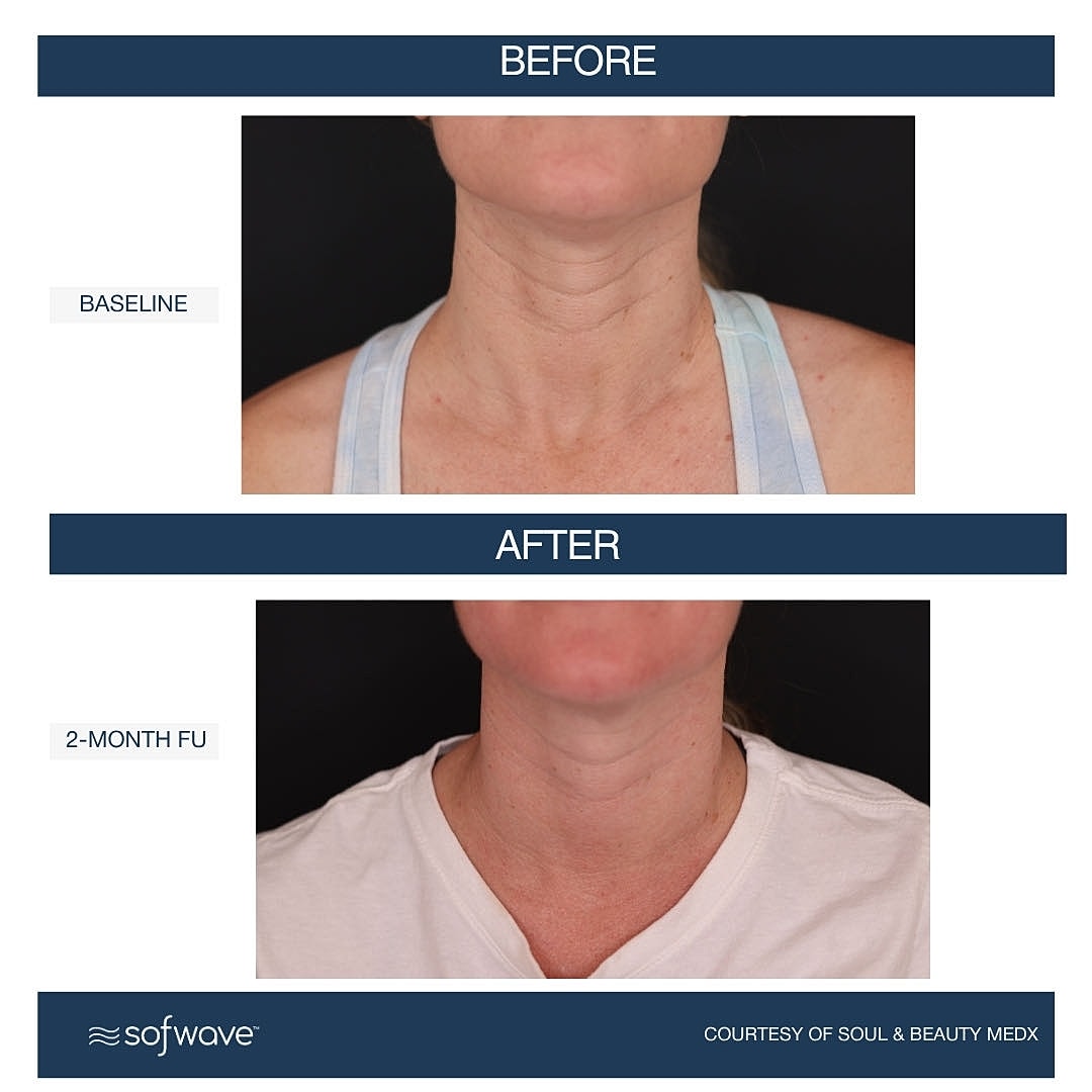 sofwave treatment sagging skin neck glp-1 Rejuvenation How Sofwave Bridges the Gap