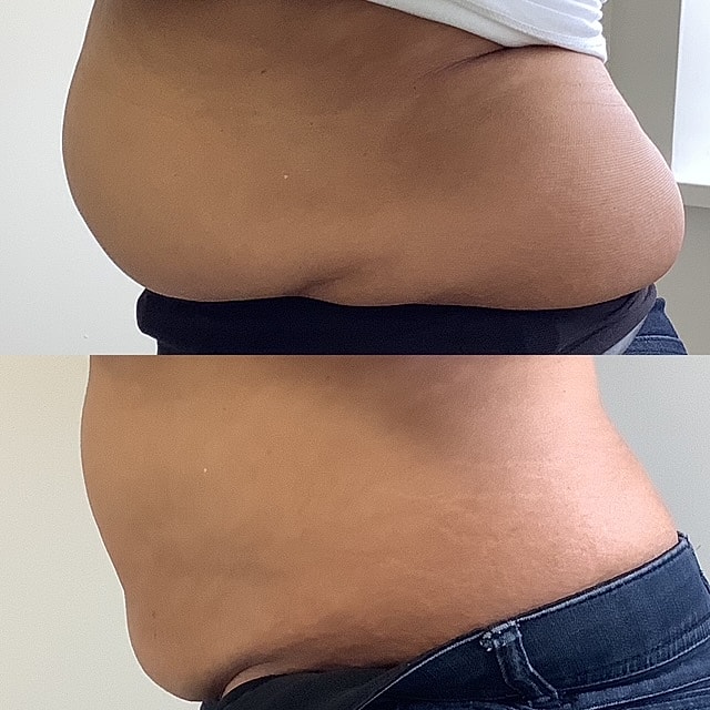 Emsculpt Before & After