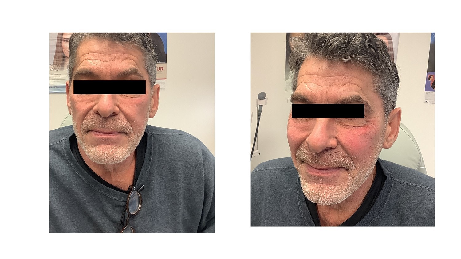  Before & After