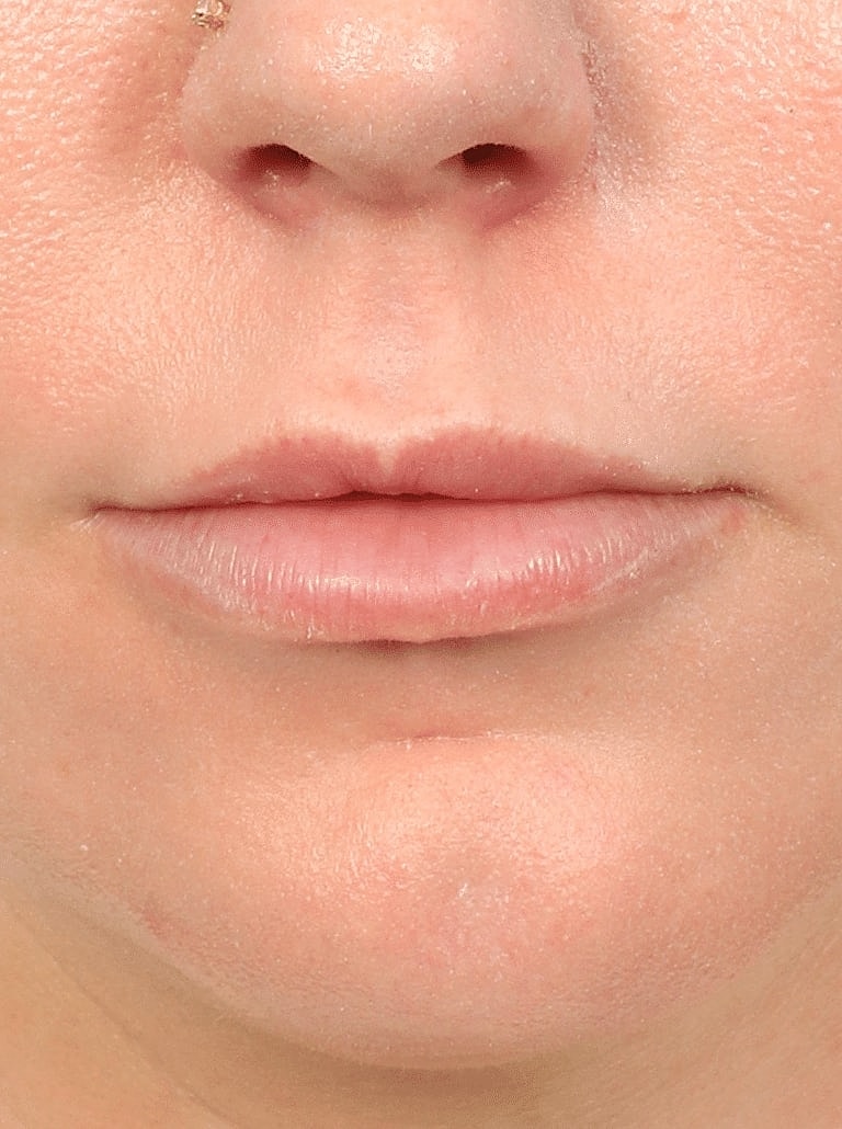 Lip Lift Surgery Washington DC