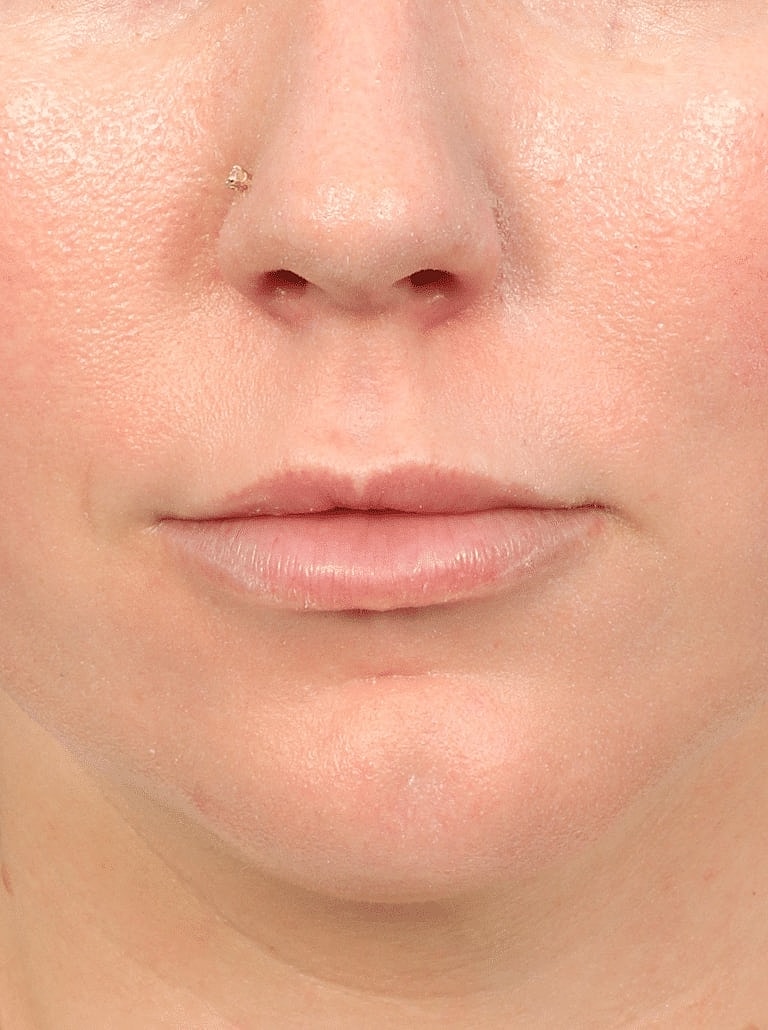 Lip Lift Surgery Washington DC