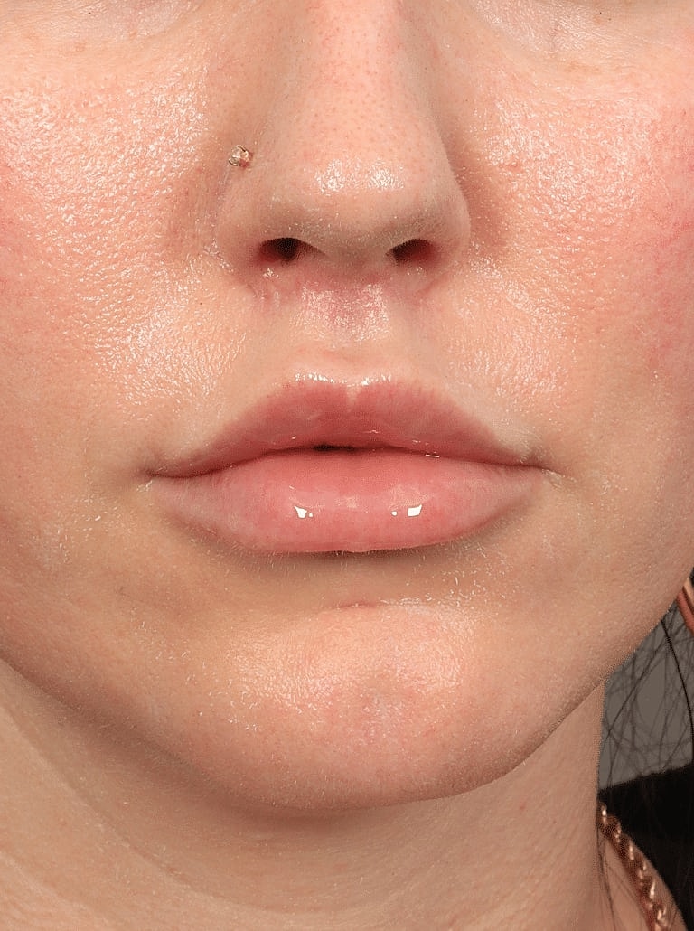Lip Lift Surgery Washington DC