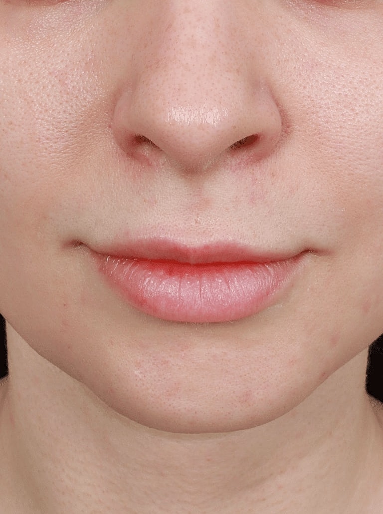 Lip Lift Surgery Washington DC