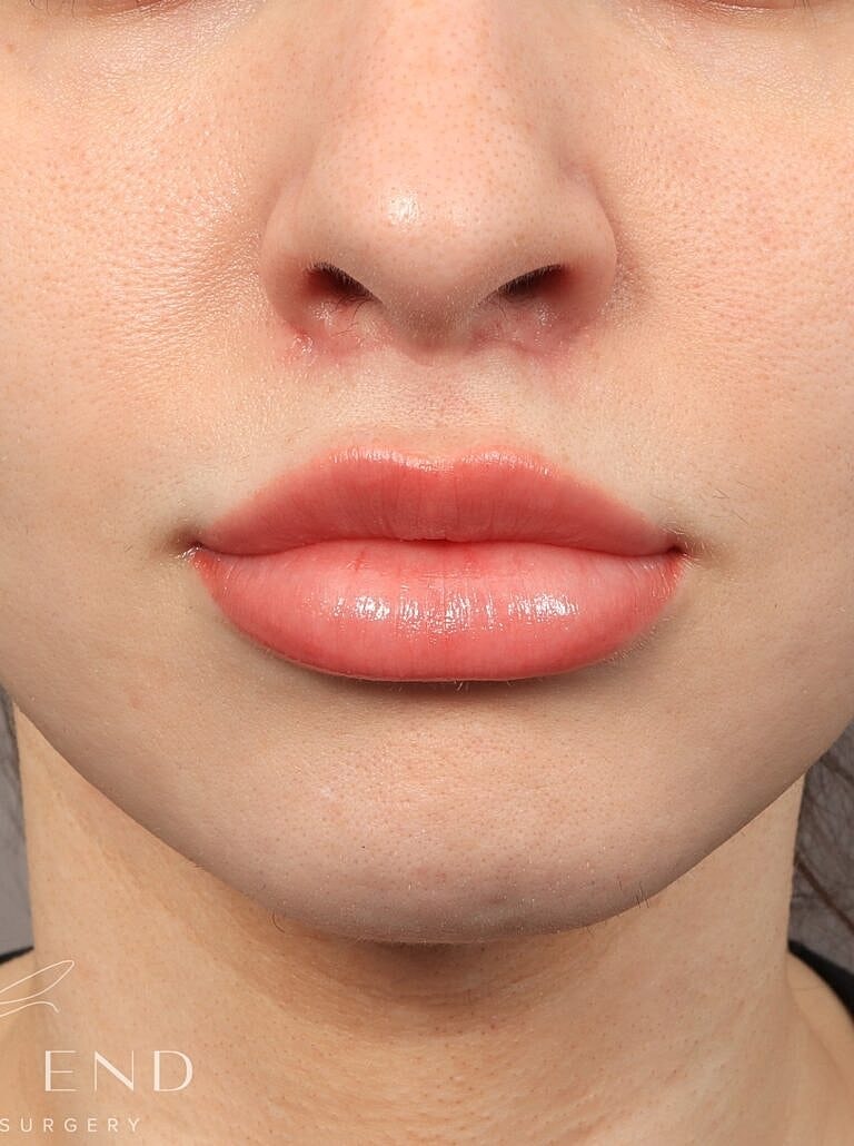 Lip Lift Surgery Washington DC