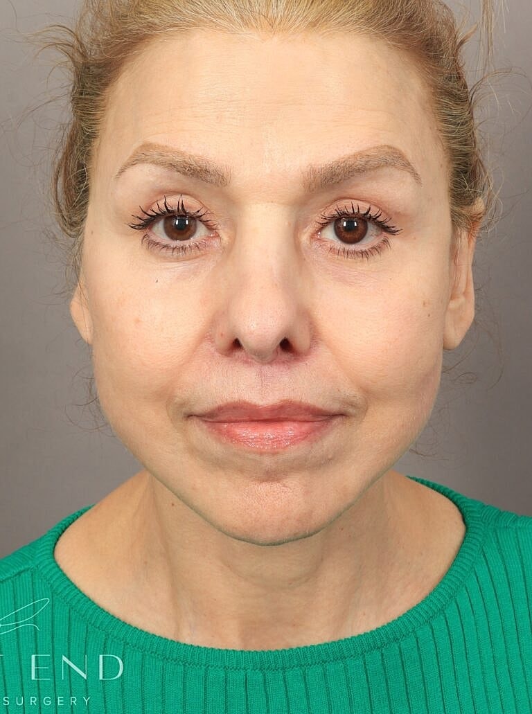 Lip Lift Surgery Washington DC