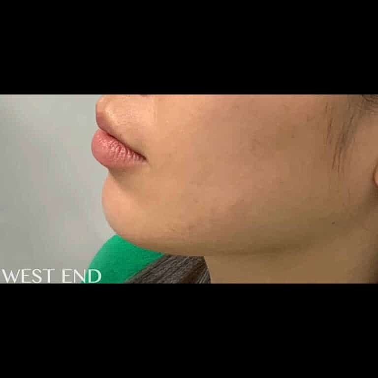 lip filler washington d.c. Lip Fillers In Washington, D.C