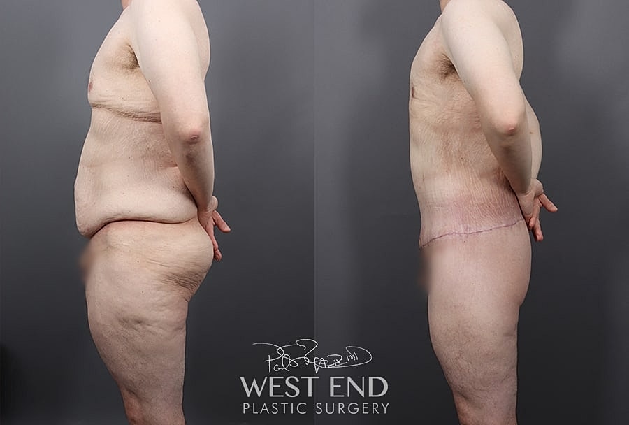 Before & After Image of Lower Body Lift Washington DC