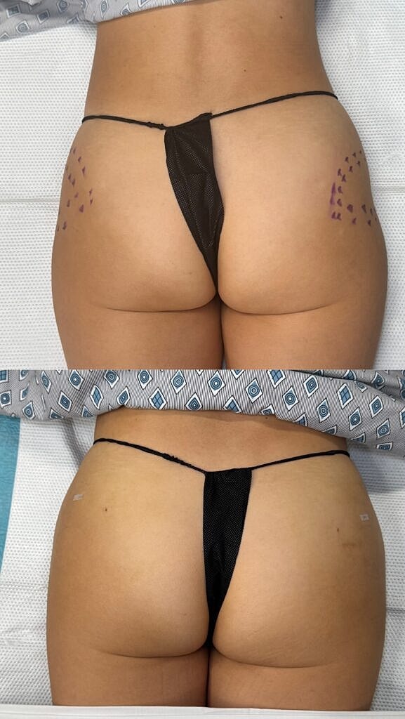 Before and After Image of AlloClae™ Washington DC