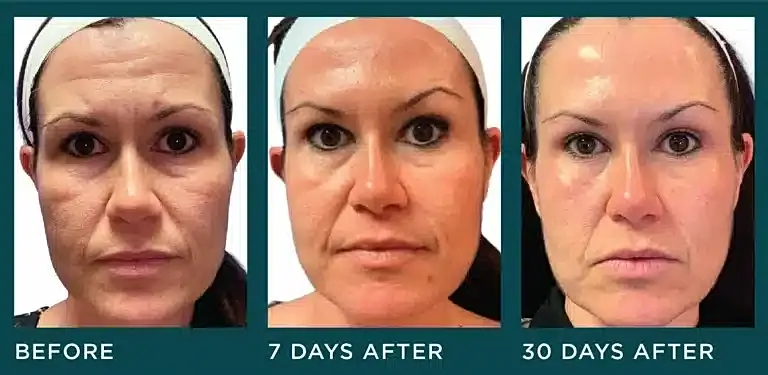 before and after BOTOX Injection treatment Washington DC