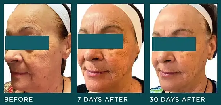 before and after BOTOX Cosmetic treatment Washington DC